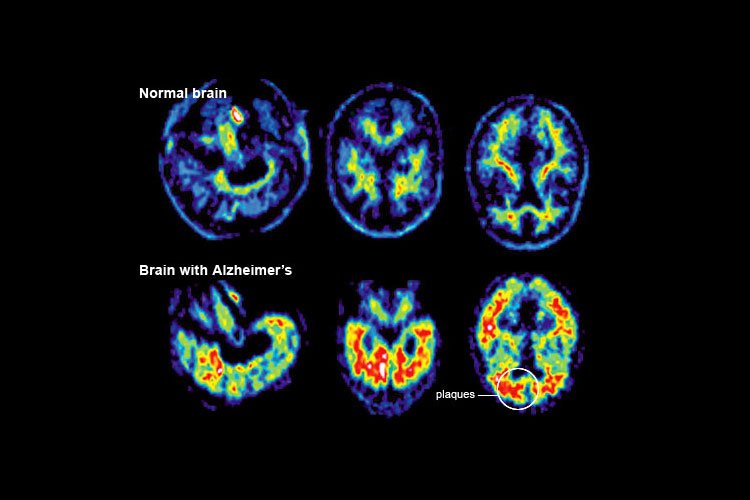 New Alzheimer’s Disease Test