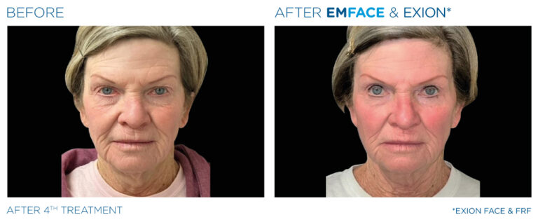 Emface and Exion Treatment - Before and After - Heal n Cure Medical Wellness Center