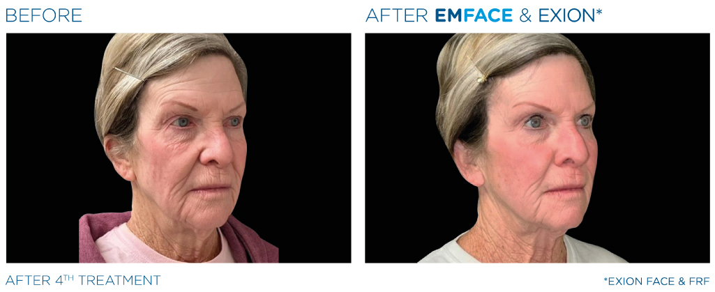 Emface and Exion Treatment - Before and After - Heal n Cure Medical Wellness Center