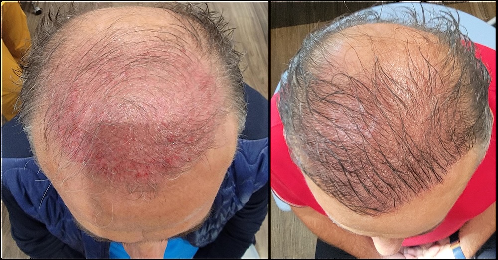 Side-by-side photos illustrate the restorative power of PRP scalp injections performed at our men's health clinic in Glenview.